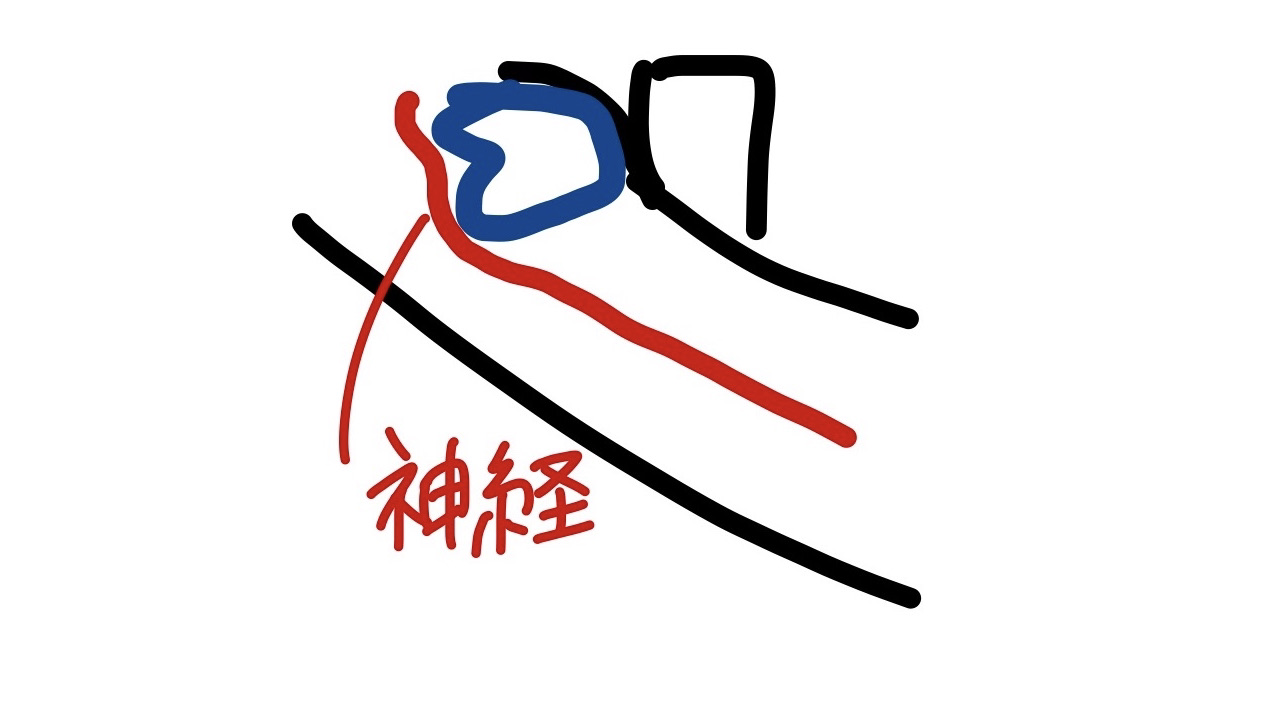 親知らず4本同時抜歯 全身麻酔で手術 入院までしちゃった話 夢見る少女は旅に出る